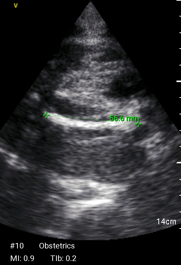 femur length ultrasound dating