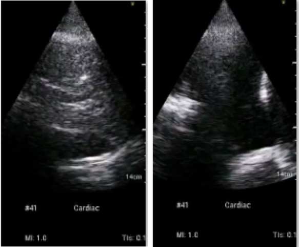Hepatization of the left lung with static air bronchograms and a shred sign with an associated moderate sized left pleural effusion.